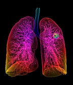 Lung cancer, 3D CT scan