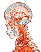 Intracranial and neck blood vessels, 3D CT angiogram