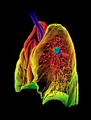Lung cancer, 3D CT scan