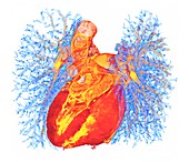 Human heart and lung bronchioles, 3D CT scan