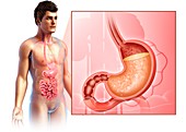 Man with stomach acidity, illustration