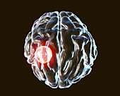 Brain abscess caused by Toxoplasma gondii, illustration