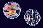 Brain abscess caused by Toxoplasma gondii, illustration