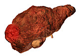 Cirrhotic liver with hepatocellular carcinoma, illustration