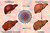 Stages of liver disease in hepatitis C, illustration
