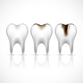 Tooth decay, illustration