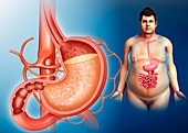 Man with stomach acidity, illustration