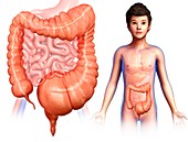 Child with mega colon, illustration