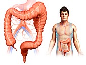 Man with mega colon, illustration