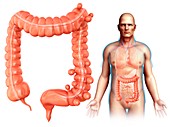 Man with diverticulosis, illustration