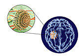 Aspergilloma of the brain, illustration