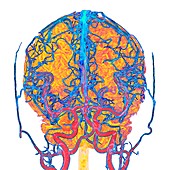 Brain blood vessels, 3D MRI and CT scans