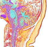 Rear of brain and spinal cord, MRI scan