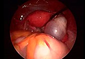 Ovarian cyst, endoscope view