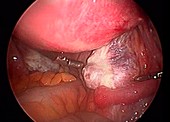Ovary, endoscope view