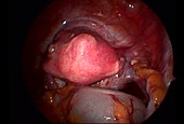 Uterine fibroid, endoscope view
