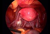 Uterus and fallopian tubes, endoscope view