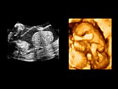 Twin foetuses, ultrasound scans