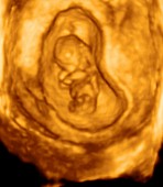Foetus at 11 weeks, 3D ultrasound scan