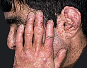 Skin in porphyria