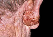 Skin in mycosis fungoides cancer