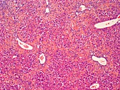 Viral hepatitis, light micrograph