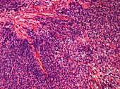 Fibrosarcoma, light micrograph