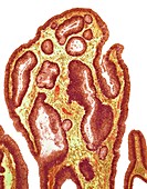 Adenoma of colon, light micrograph