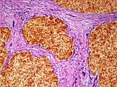 Liver cancer, light micrograph
