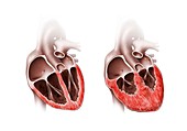 Normal and enlarged hearts, illustration