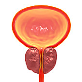 Benign prostatic hyperplasia, illustration