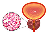 Benign prostatic hyperplasia, LM and illustration