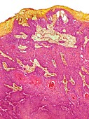 Skin cancer, light micrograph