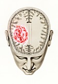 Glioma brain tumour, illustration