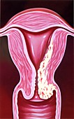 Invasive cancer of the cervix, illustration