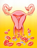 Heavy bleeding in menstruation, illustration