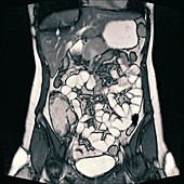 Small intestines, CT enterography scan