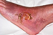 Infected ulcer with cellulitis