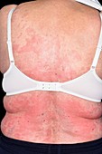 Urticaria rash on the back