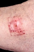 Allergic reaction to wound dressing