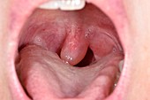 Swollen uvula in pregnant woman