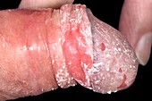 Penile candidiasis