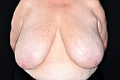 Large breasts causing neck pain