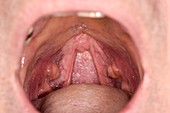 Tonsillar cysts