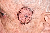 Skin graft after basal cell carcinoma excision