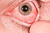 Allergic conjunctivitis