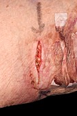 Ruptured surgical wound