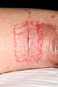 Allergic reaction on surgical wound
