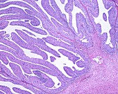 Urinary bladder papilloma, light micrograph