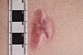Burns scar